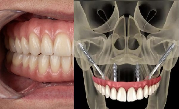 Zygomatic Implant